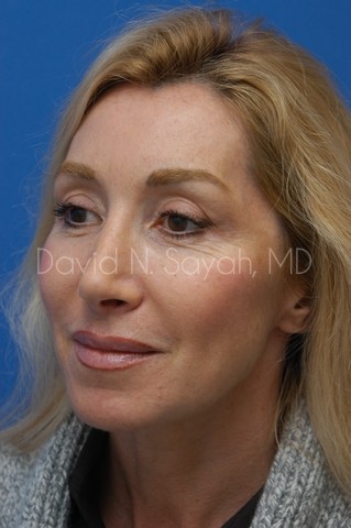 Fat Injection Face Before and After | Sayah Institute
