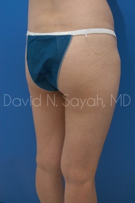 Gluteal Augmentation Before and After | Sayah Institute