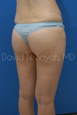 Gluteal Augmentation Before and After | Sayah Institute