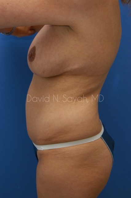 Gluteal Augmentation Before and After | Sayah Institute