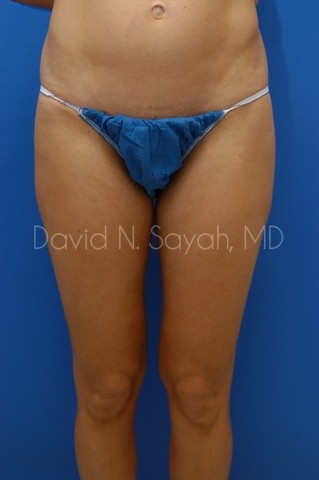 Gluteal Augmentation Before and After | Sayah Institute