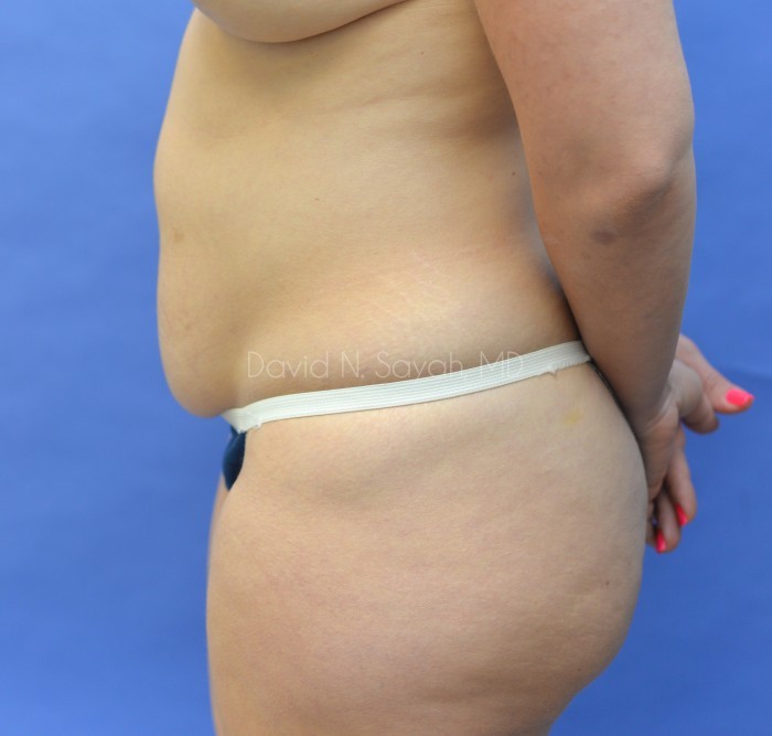 Liposuction Before and After | Sayah Institute