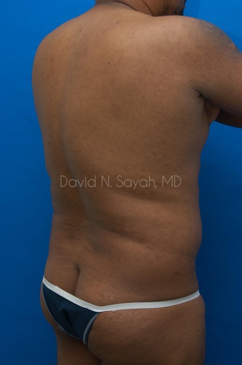 Liposuction Before and After | Sayah Institute