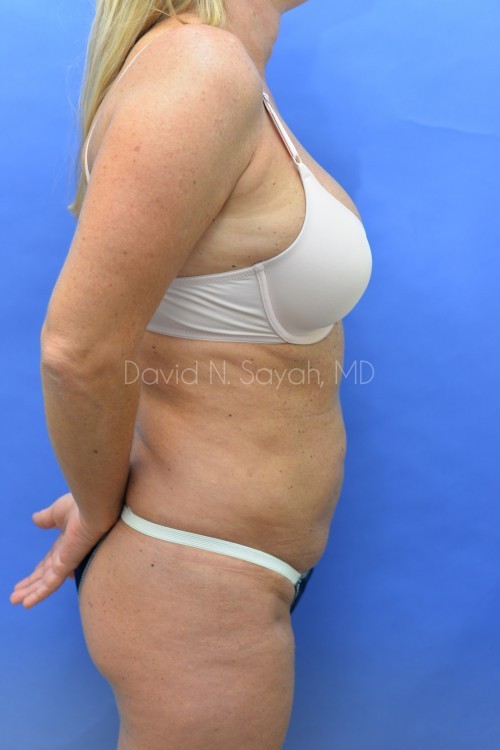 Liposuction Before and After | Sayah Institute