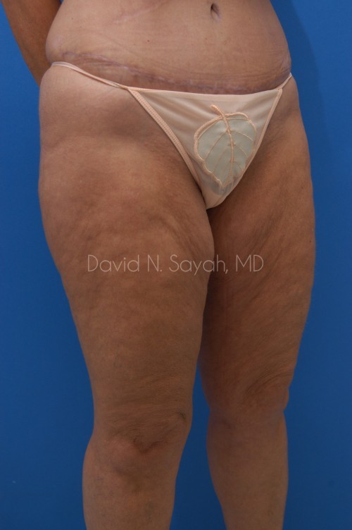Liposuction Before and After | Sayah Institute