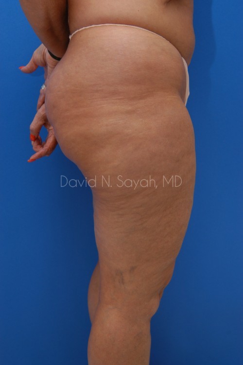 Liposuction Before and After | Sayah Institute