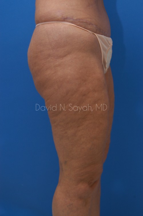 Liposuction Before and After | Sayah Institute