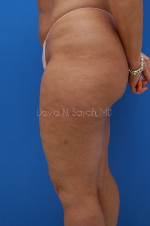 Liposuction Before and After | Sayah Institute