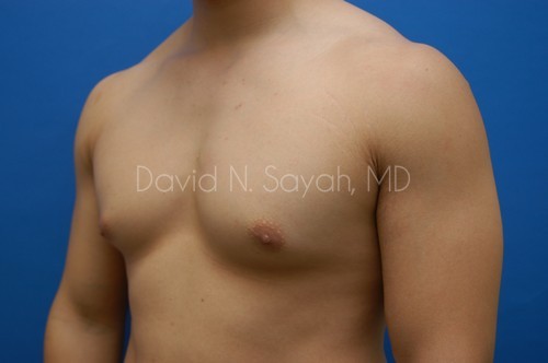 Liposuction Before and After | Sayah Institute
