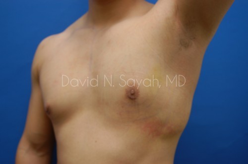 Liposuction Before and After | Sayah Institute