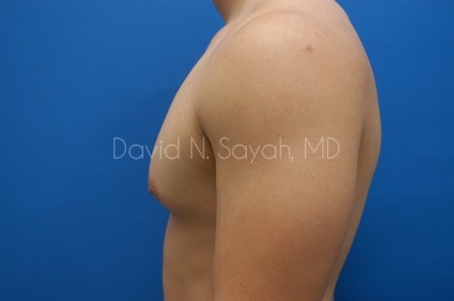 Liposuction Before and After | Sayah Institute