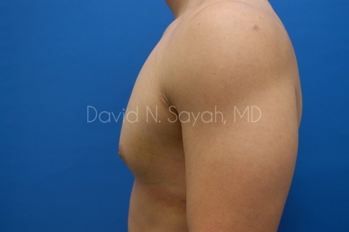 Liposuction Before and After | Sayah Institute