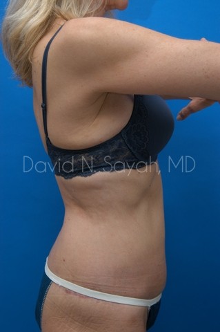 Liposuction Before and After | Sayah Institute