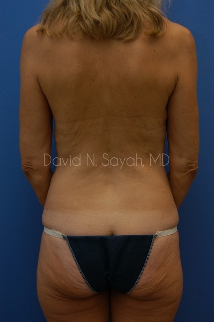 Liposuction Before and After | Sayah Institute
