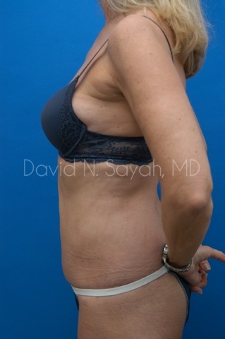 Liposuction Before and After | Sayah Institute