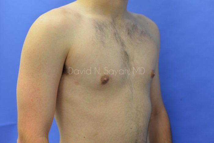 Male Breast Surgery Before and After | Sayah Institute