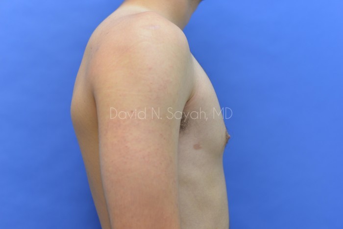 Male Breast Surgery Before and After | Sayah Institute