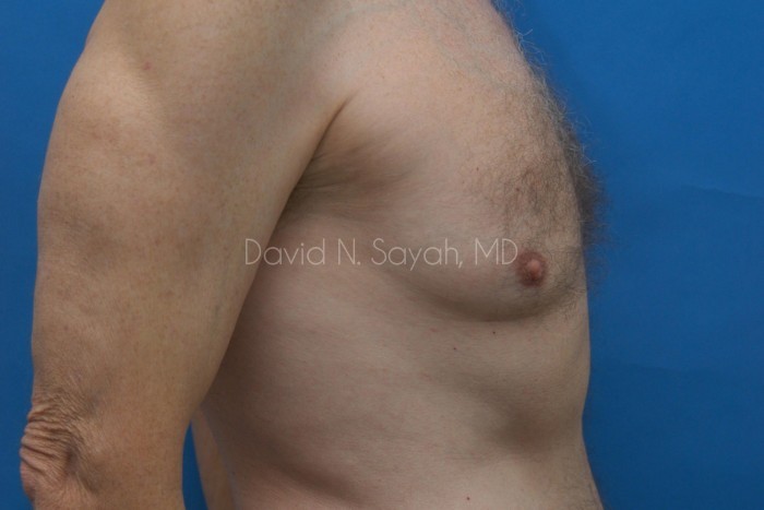 Male Breast Surgery Before and After | Sayah Institute