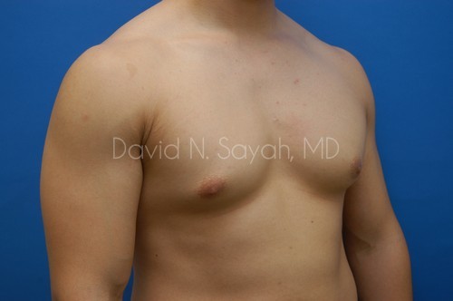Male Breast Surgery Before and After | Sayah Institute