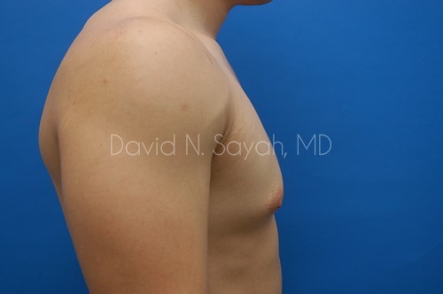 Male Breast Surgery Before and After | Sayah Institute