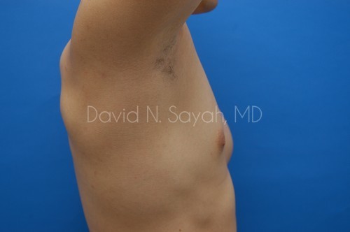 Male Breast Surgery Before and After | Sayah Institute