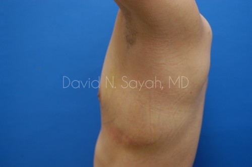 Male Breast Surgery Before and After | Sayah Institute