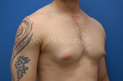 Male Breast Surgery Before and After | Sayah Institute
