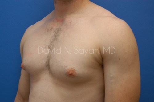 Male Breast Surgery Before and After | Sayah Institute