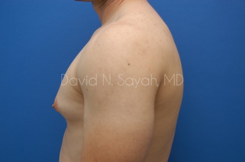 Male Breast Surgery Before and After | Sayah Institute