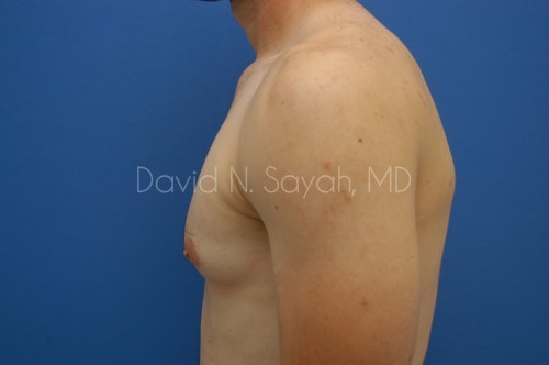 Male Breast Surgery Before and After | Sayah Institute