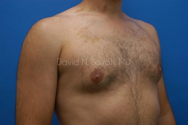 Male Breast Surgery Before and After | Sayah Institute