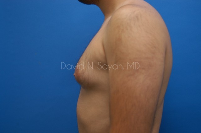 Male Breast Surgery Before and After | Sayah Institute