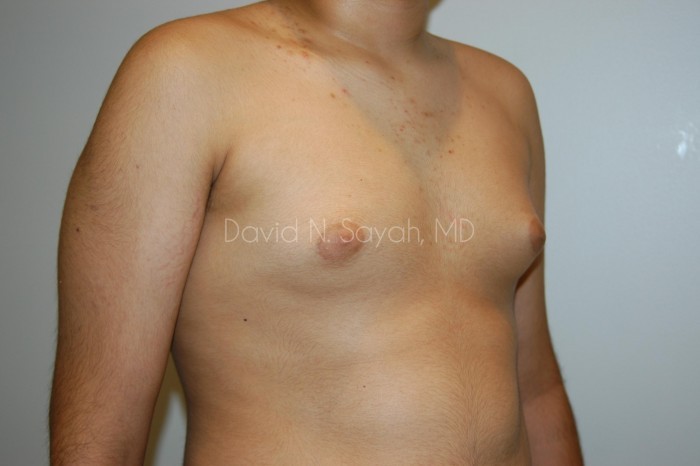 Male Breast Surgery Before and After | Sayah Institute