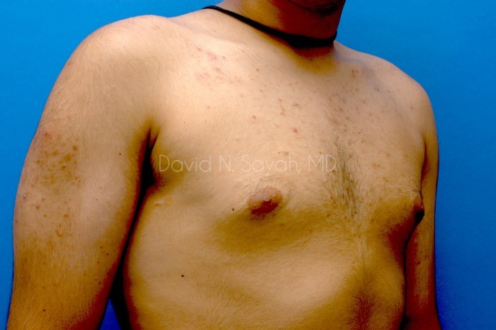 Male Breast Surgery Before and After | Sayah Institute