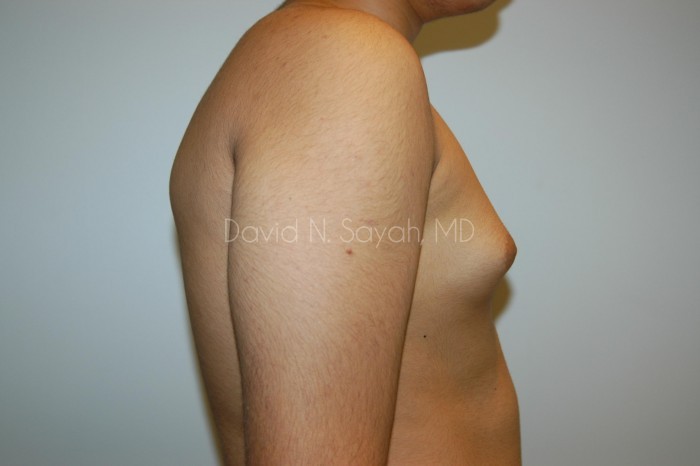 Male Breast Surgery Before and After | Sayah Institute