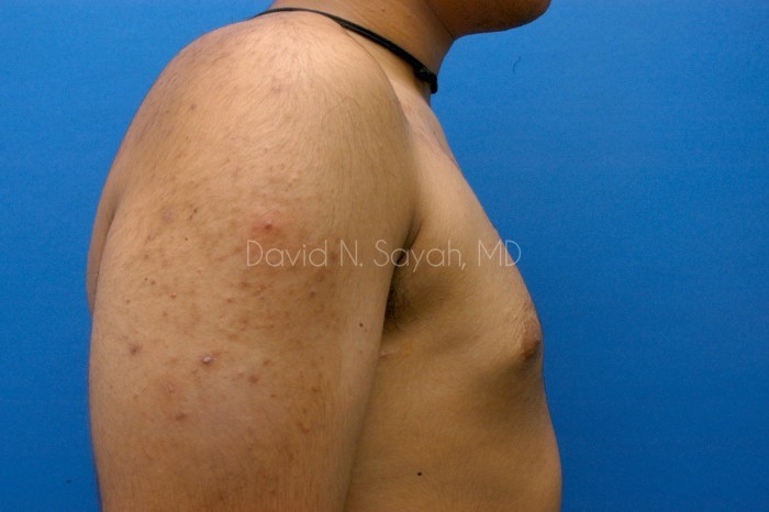 Male Breast Surgery Before and After | Sayah Institute