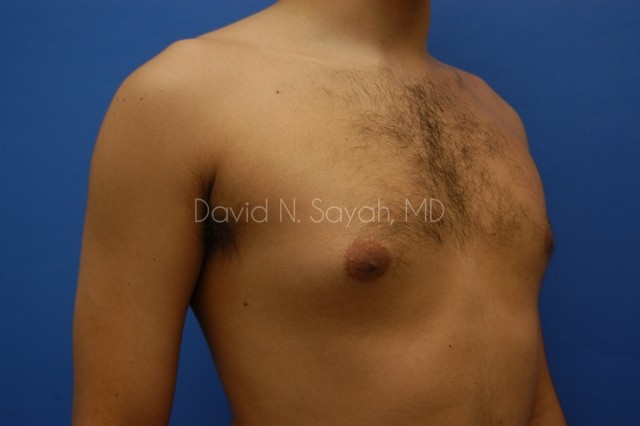 Male Breast Surgery Before and After | Sayah Institute