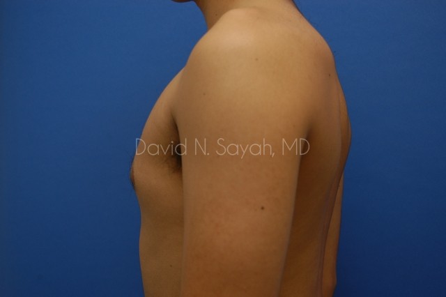 Male Breast Surgery Before and After | Sayah Institute