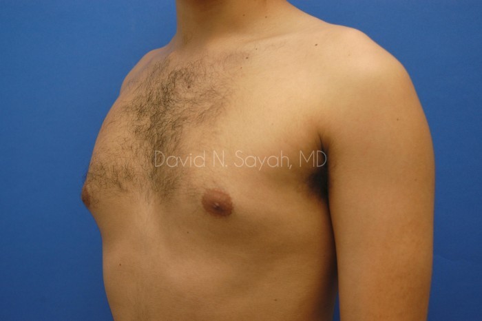 Male Breast Surgery Before and After | Sayah Institute
