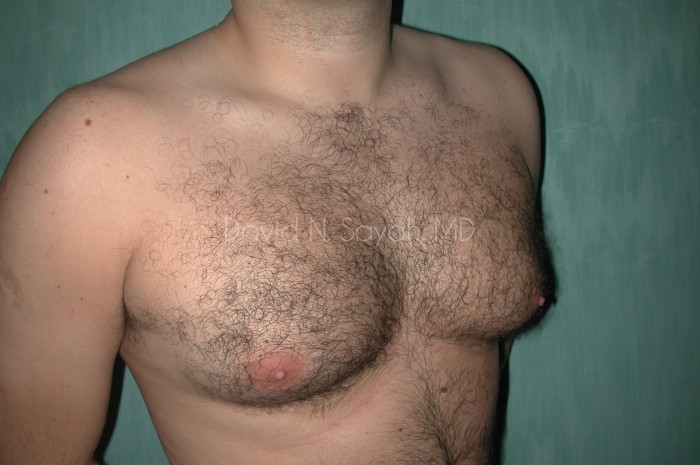 Male Breast Surgery Before and After | Sayah Institute