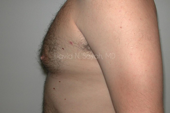 Male Breast Surgery Before and After | Sayah Institute