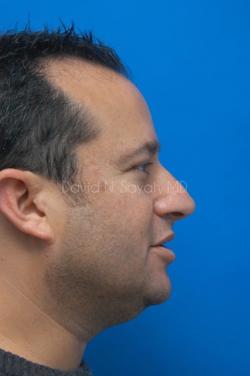 Neck Lift Before and After | Sayah Institute