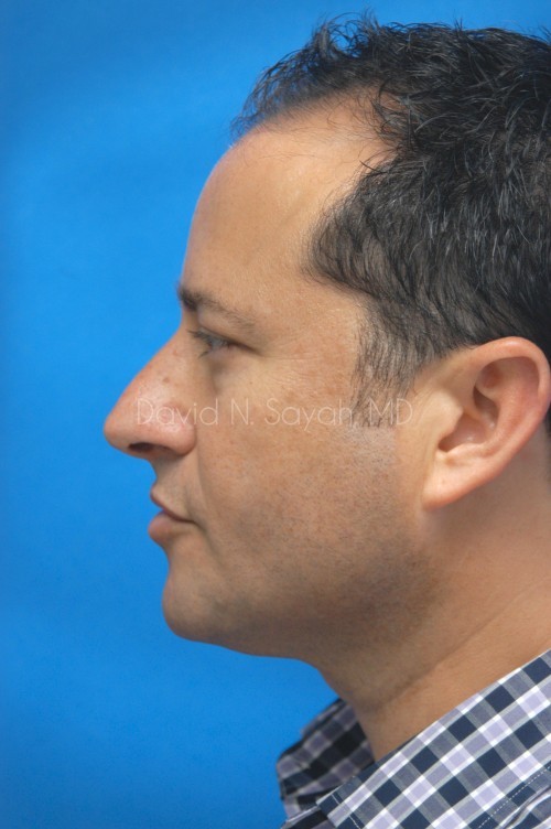 Neck Lift Before and After | Sayah Institute