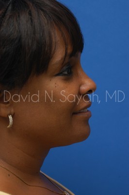 Neck Lift Before and After | Sayah Institute