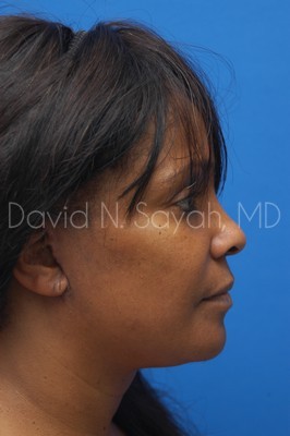 Neck Lift Before and After | Sayah Institute