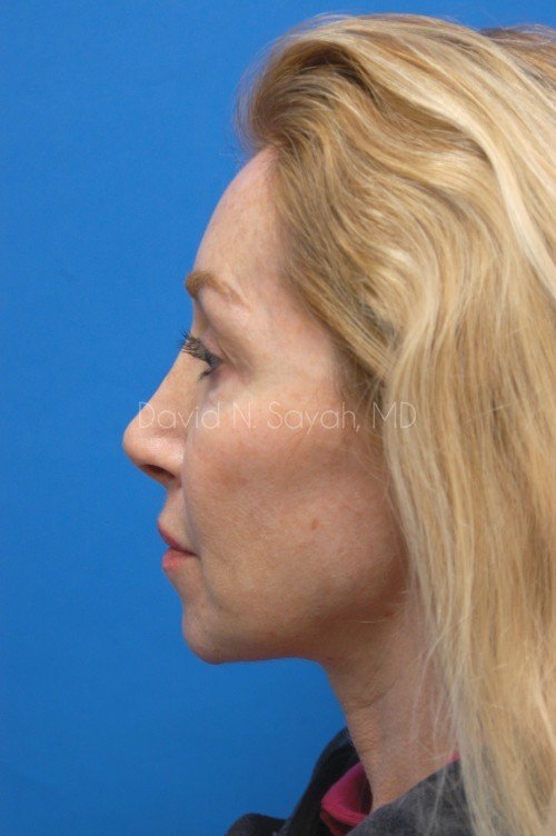 Neck Lift Before and After | Sayah Institute