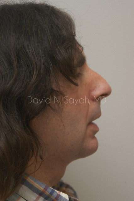 Neck Lift Before and After | Sayah Institute