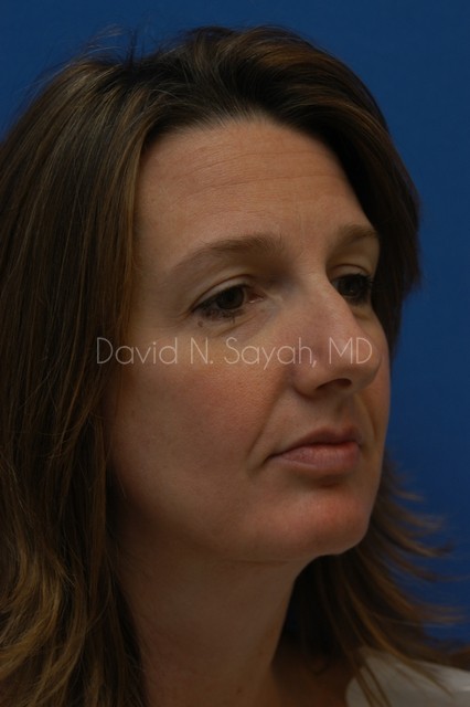 Neck Lift Before and After | Sayah Institute