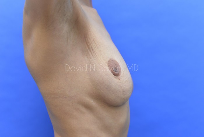Nipple Revision Before and After | Sayah Institute