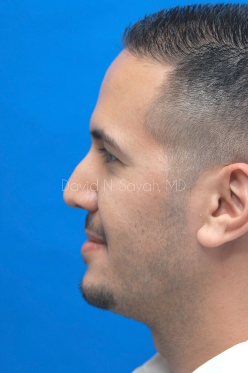 Rhinoplasty Before and After | Sayah Institute